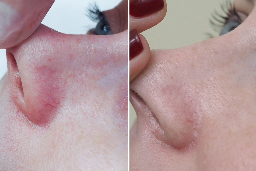 Як видаляють судини на обличчі