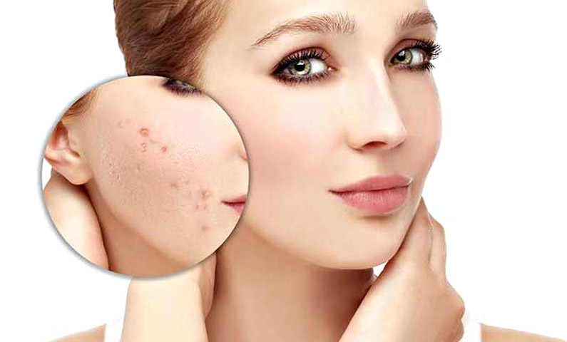 элос-терапия угревой болезни