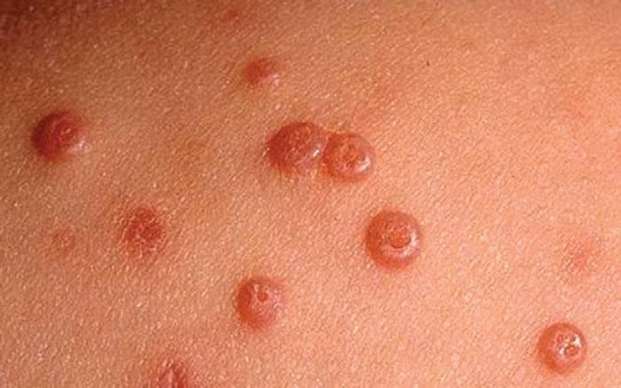 Контагиозный моллюск