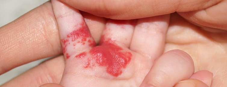 гемангіома чи потрібно видаляти