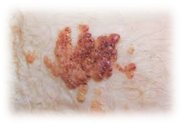 Ангиокератомы