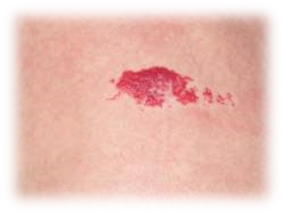 Пламенеющий невус