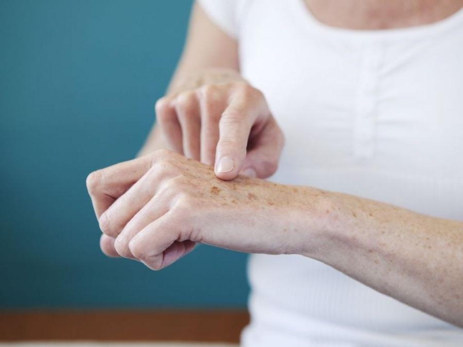 пигментация на руках