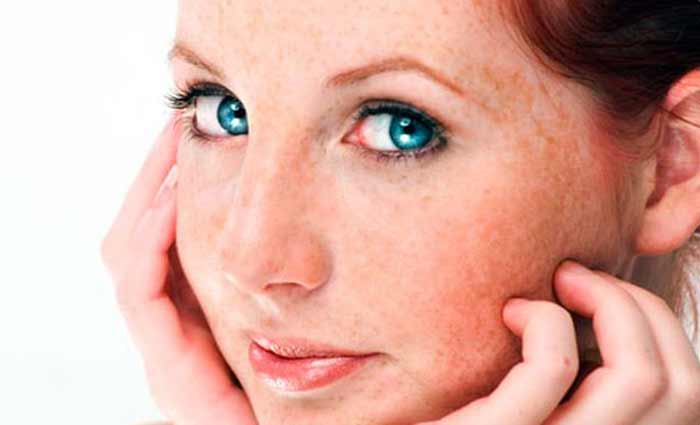 як позбутися від розацеа назавжди