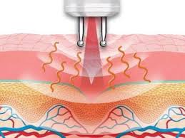 видалення татуажу повік