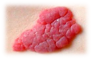 Гемангиома