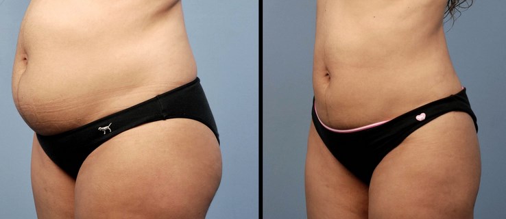 Протипоказання до безопераційної ліпосакції