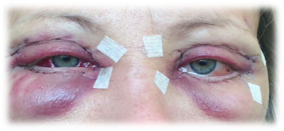 операционная блефаропластика