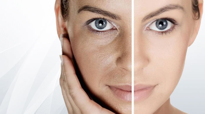 rf ліфтинг наслідки